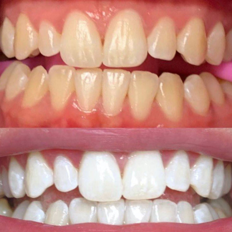 Blanchiment dentaire cosmétique 4 séances