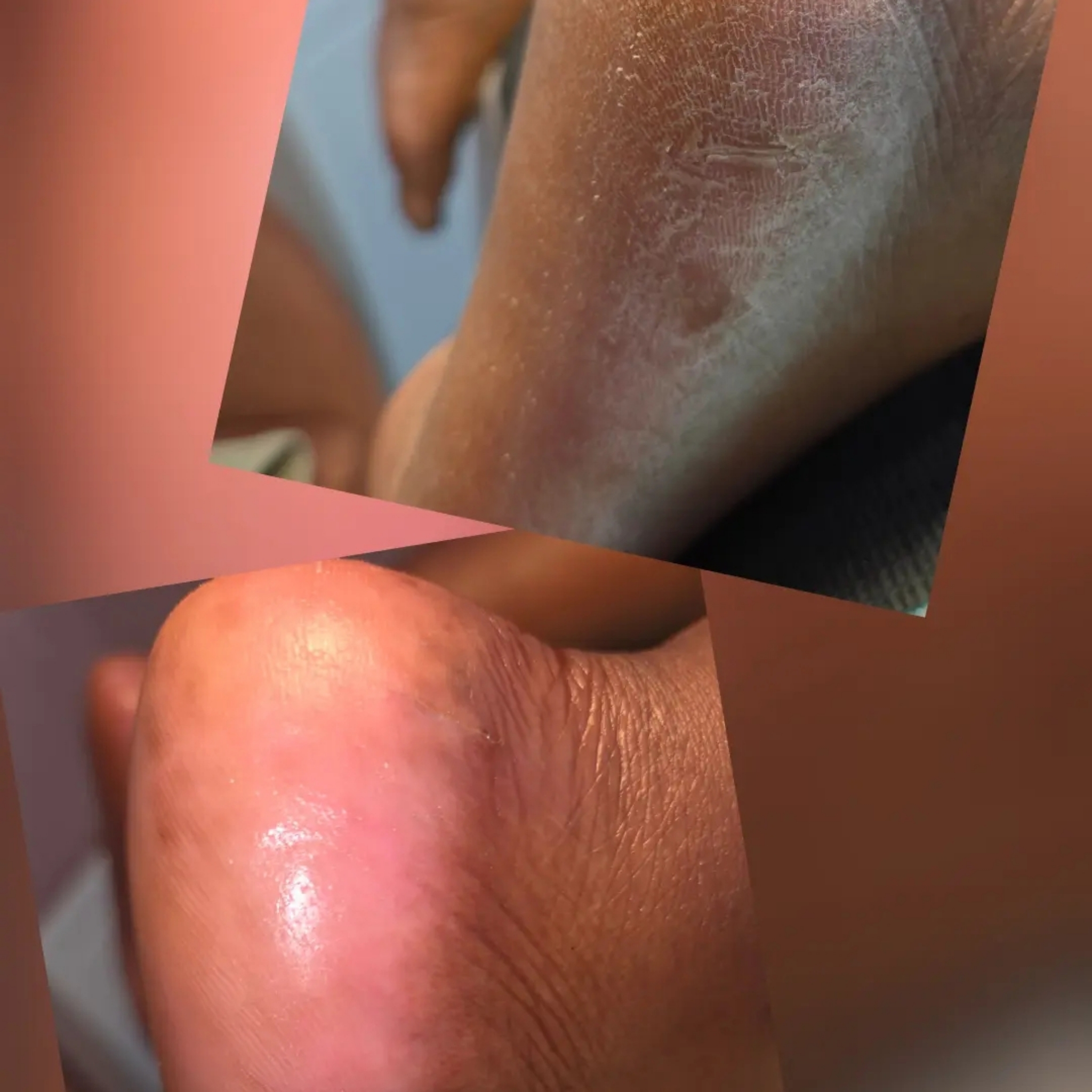 Soin des callosités russe