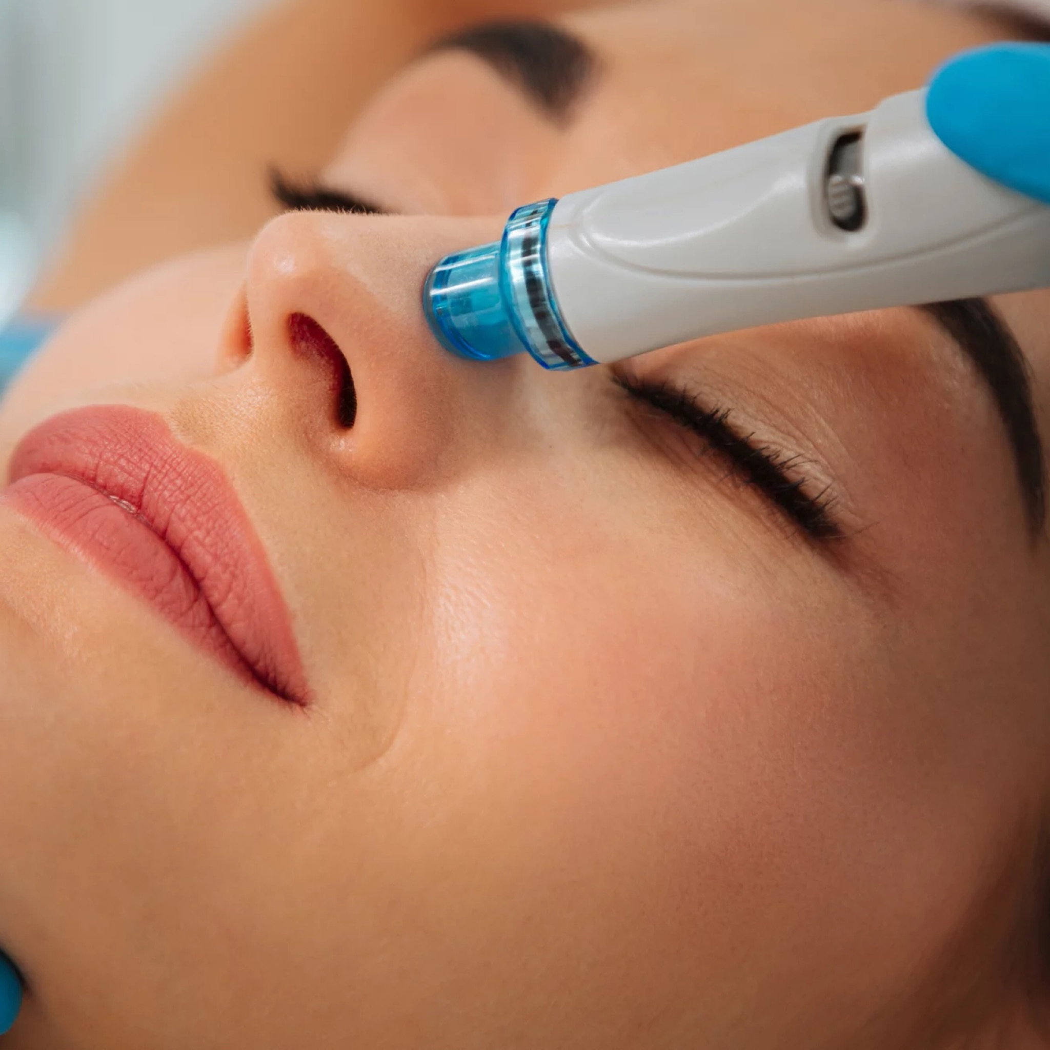 Prístrojové kozmetické ošetrenie HydraFacial (exclusive)
