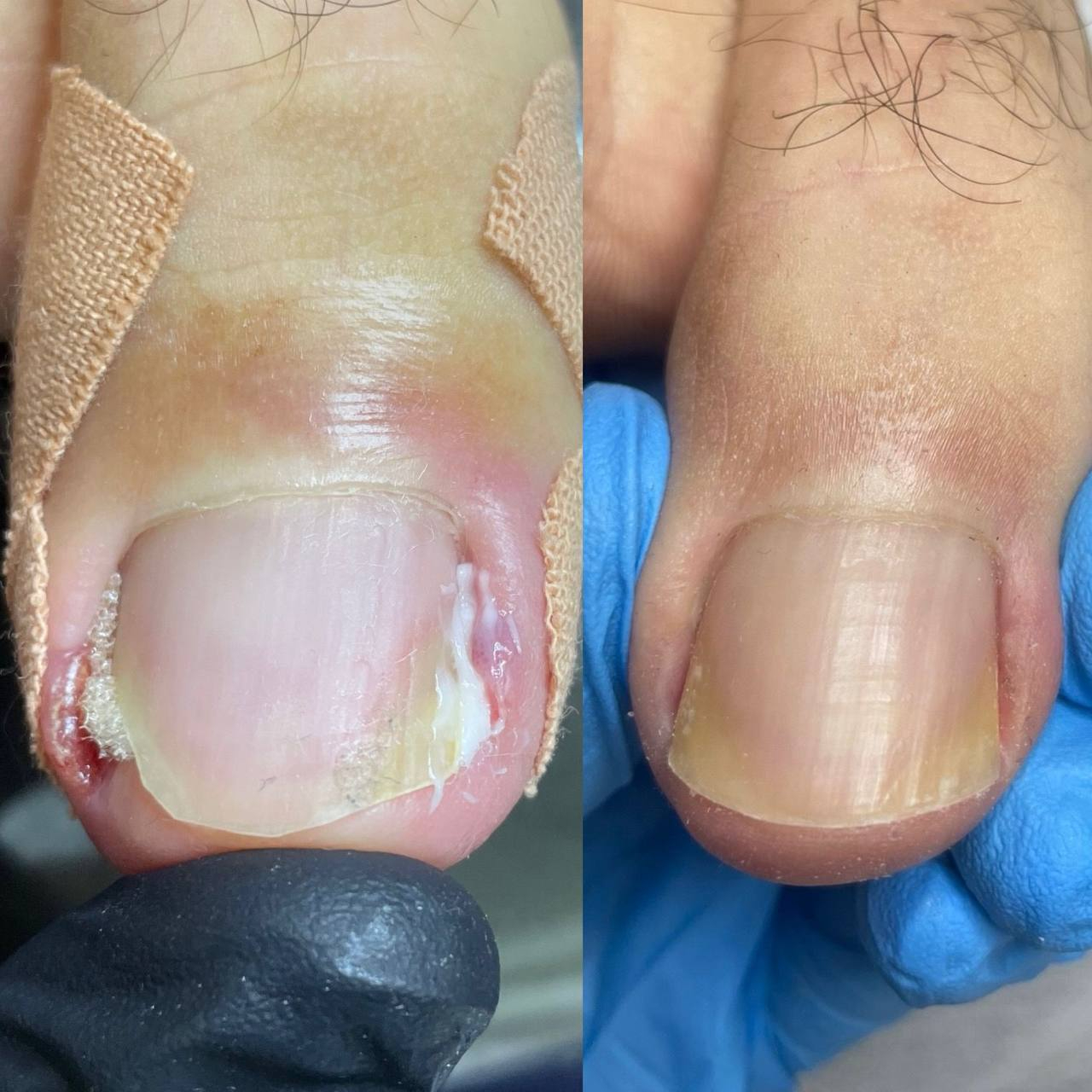 Ošetření dvou zarůstajících nehtů