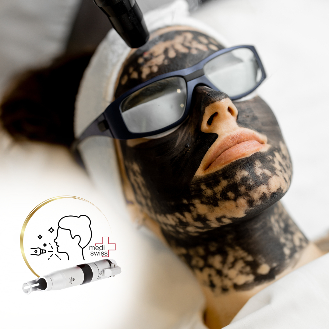 KARBONOVÝ PEELING - (obličej+krk)