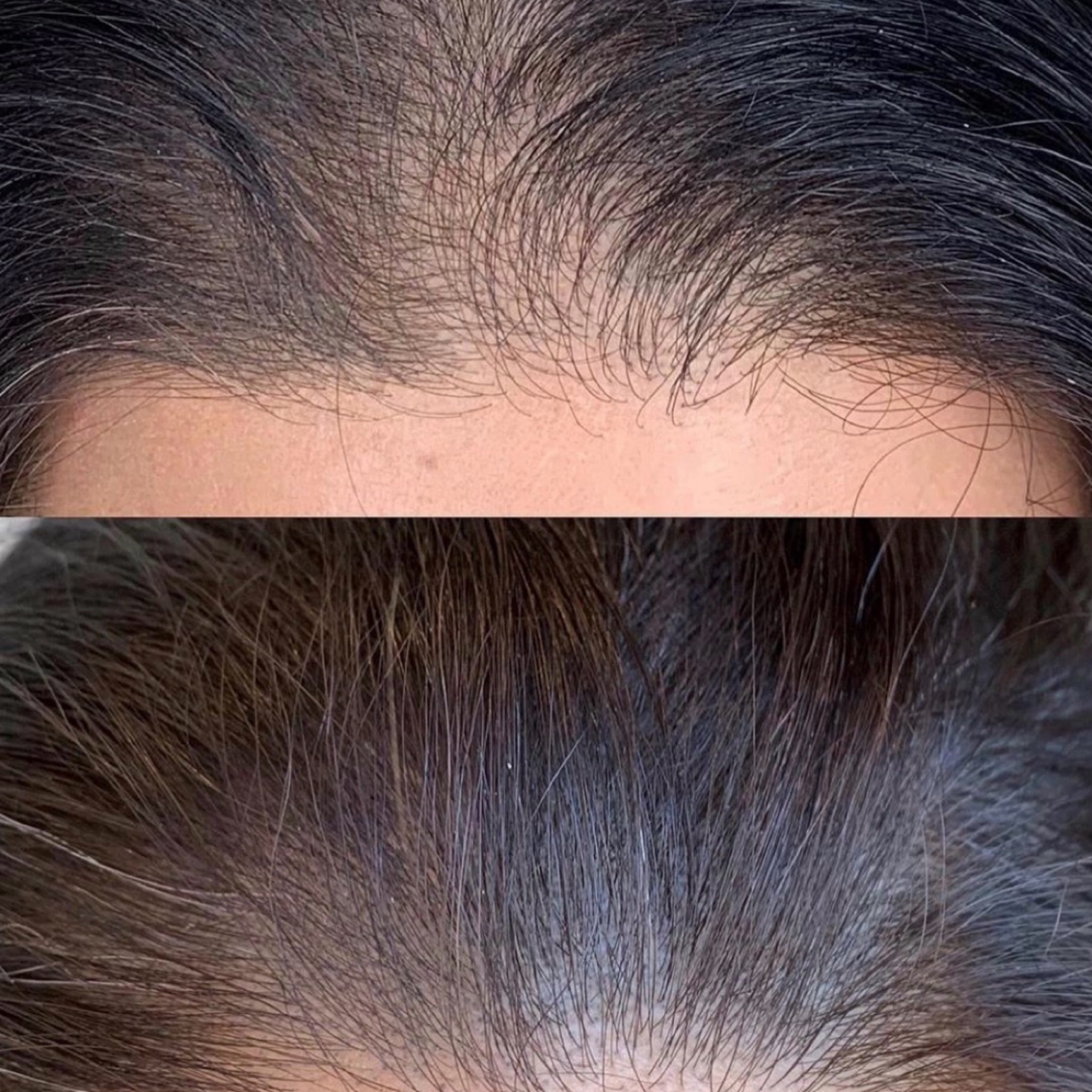 Tratamiento de anti caída capilar con dermapen