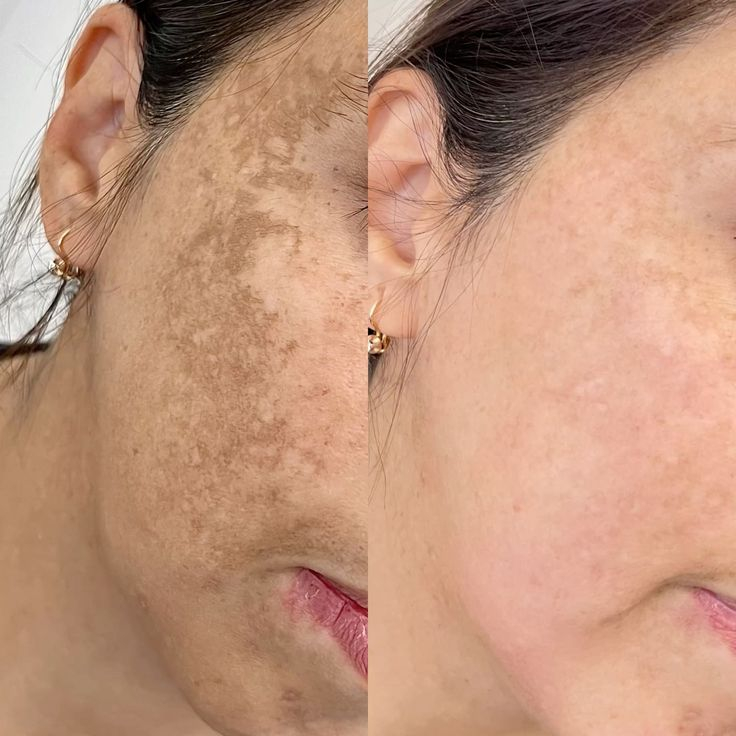 PURE SKIN | Aknozní & mastná pleť