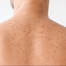 IPL odstranění pigmentace záda