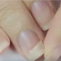 Ongle cassé