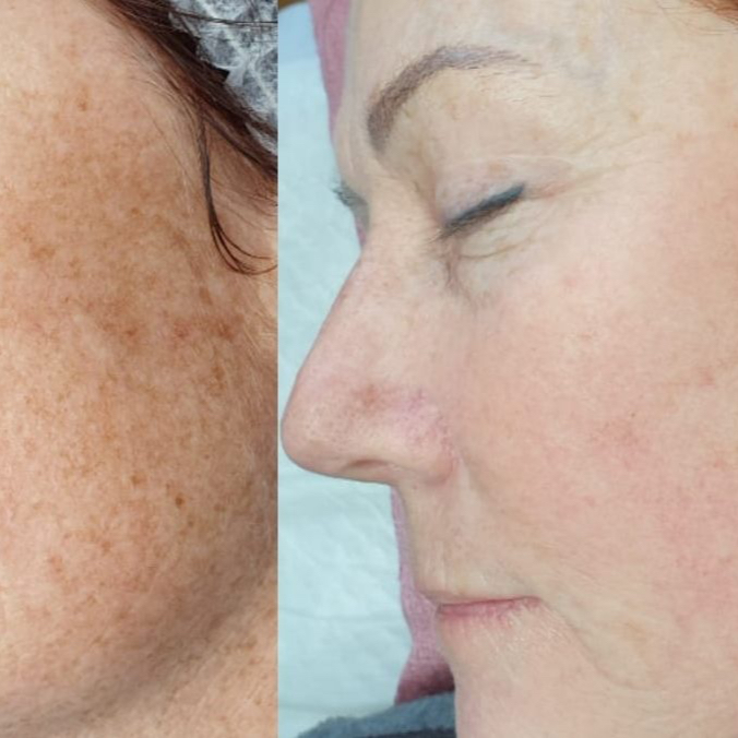 IPL odstranění pigmentace - obličej