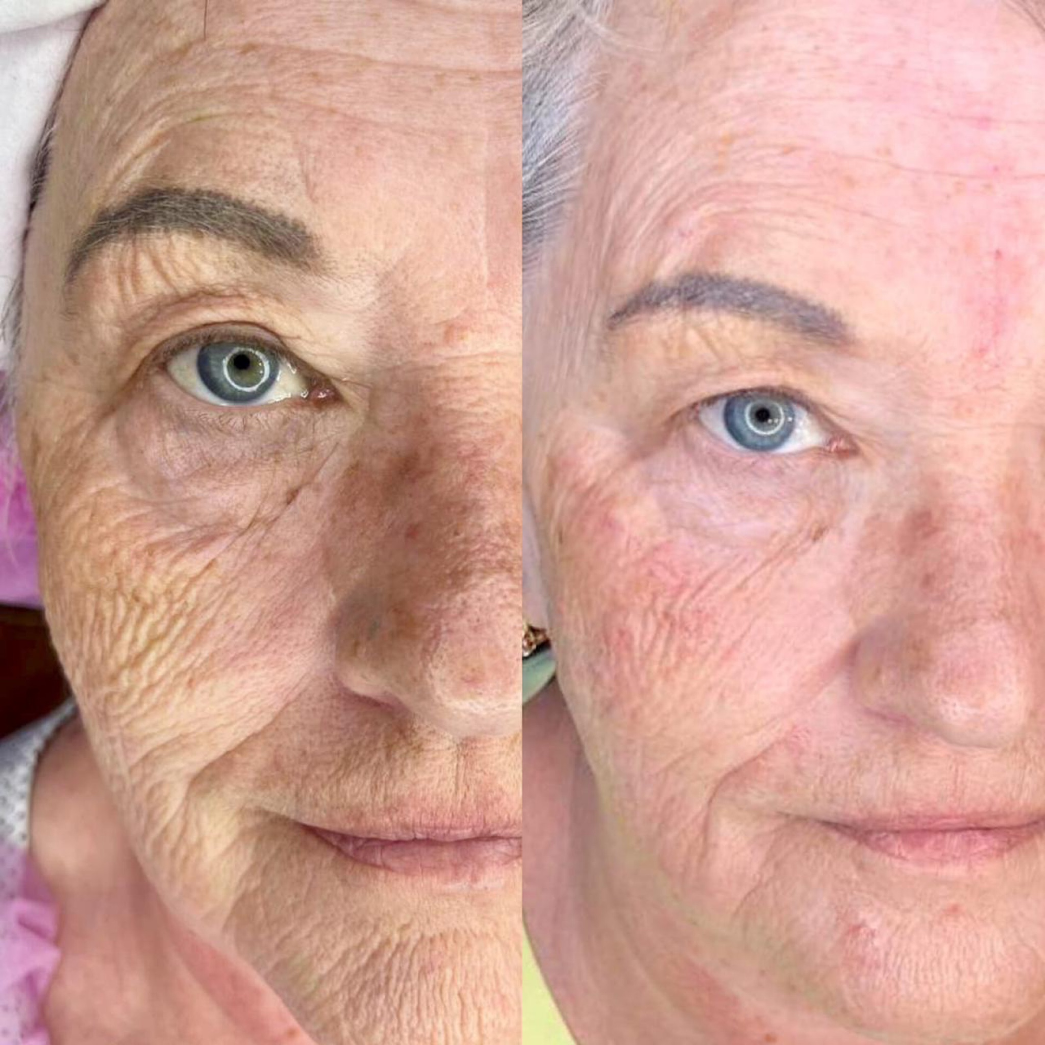 Tratamiento facial con EXOSOMAS