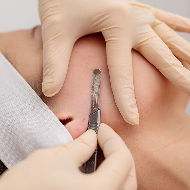 Dermaplaning + microneedling