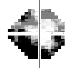Glaucoma Assessment