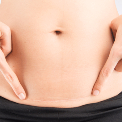 Massage after C- section / operation 60 min