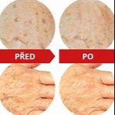 CHEMICKÝ PEELING hřbety rukou včetně krému (bez kosmetického oše