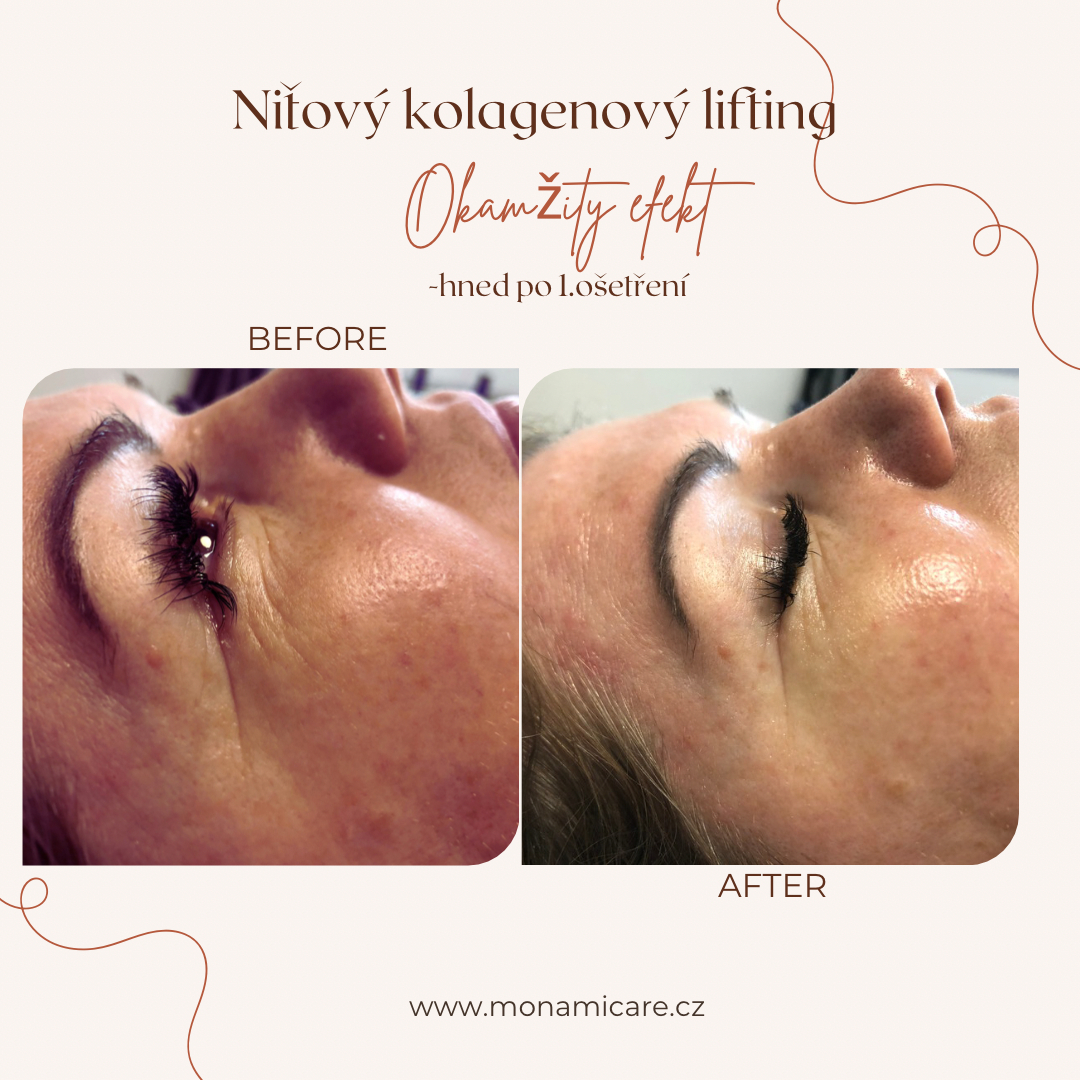 ✨ Niťový kolagenový lifting — omlazení bez skalpelu“
