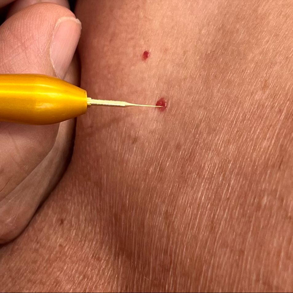 TELEANGITRON -chloupky, hemangiomy, žilky, milia