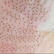 Plasma pen - horní a spodní víčka