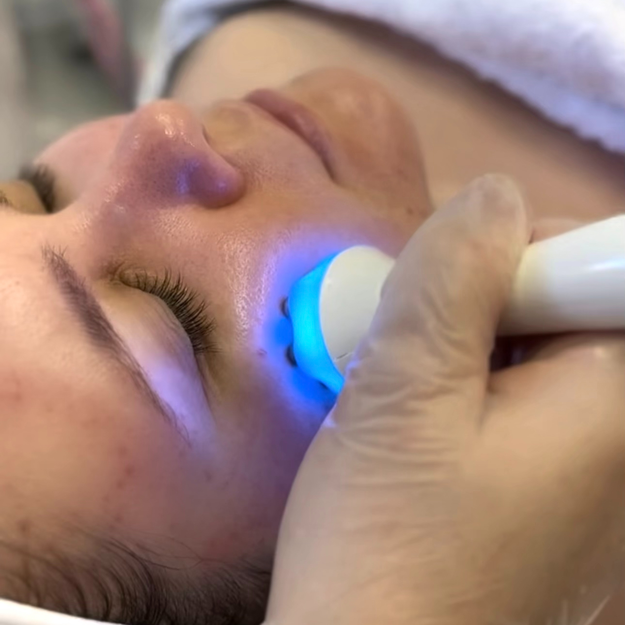 MEZOPORÁCIA – hĺbková výživa pleti, mezoterapia bez ihiel