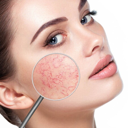 Laser capillari / angiomi cutanei: