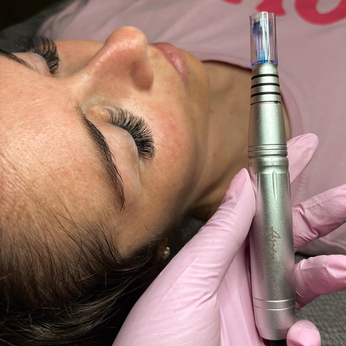 Mikrojehličkování - Microneedling