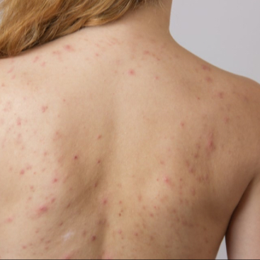 IPL léčba akné, jizvy, červené žilky - záda