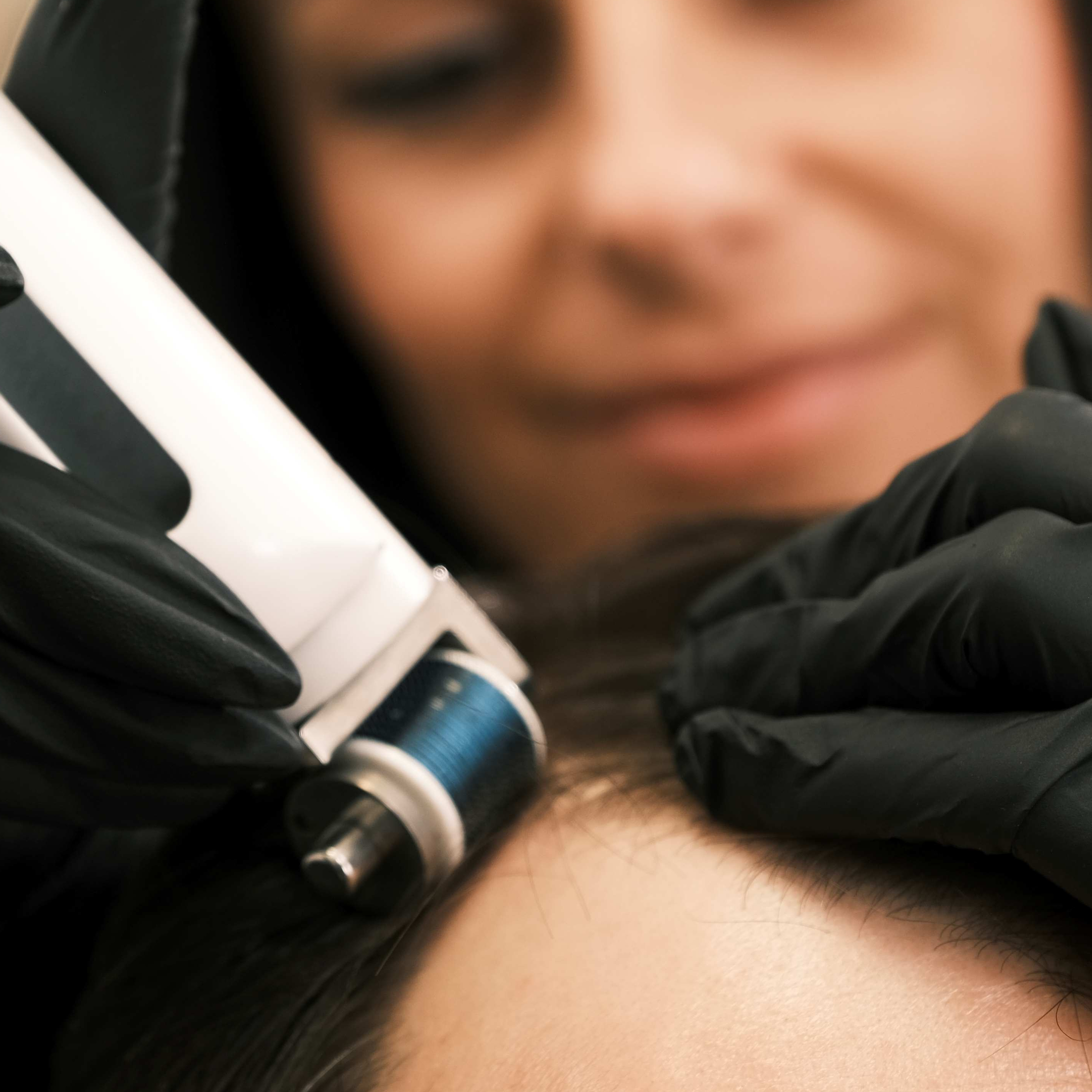 Čistenie pokožky hlavy a mikroihličkovanie - sérum NEOHAIR