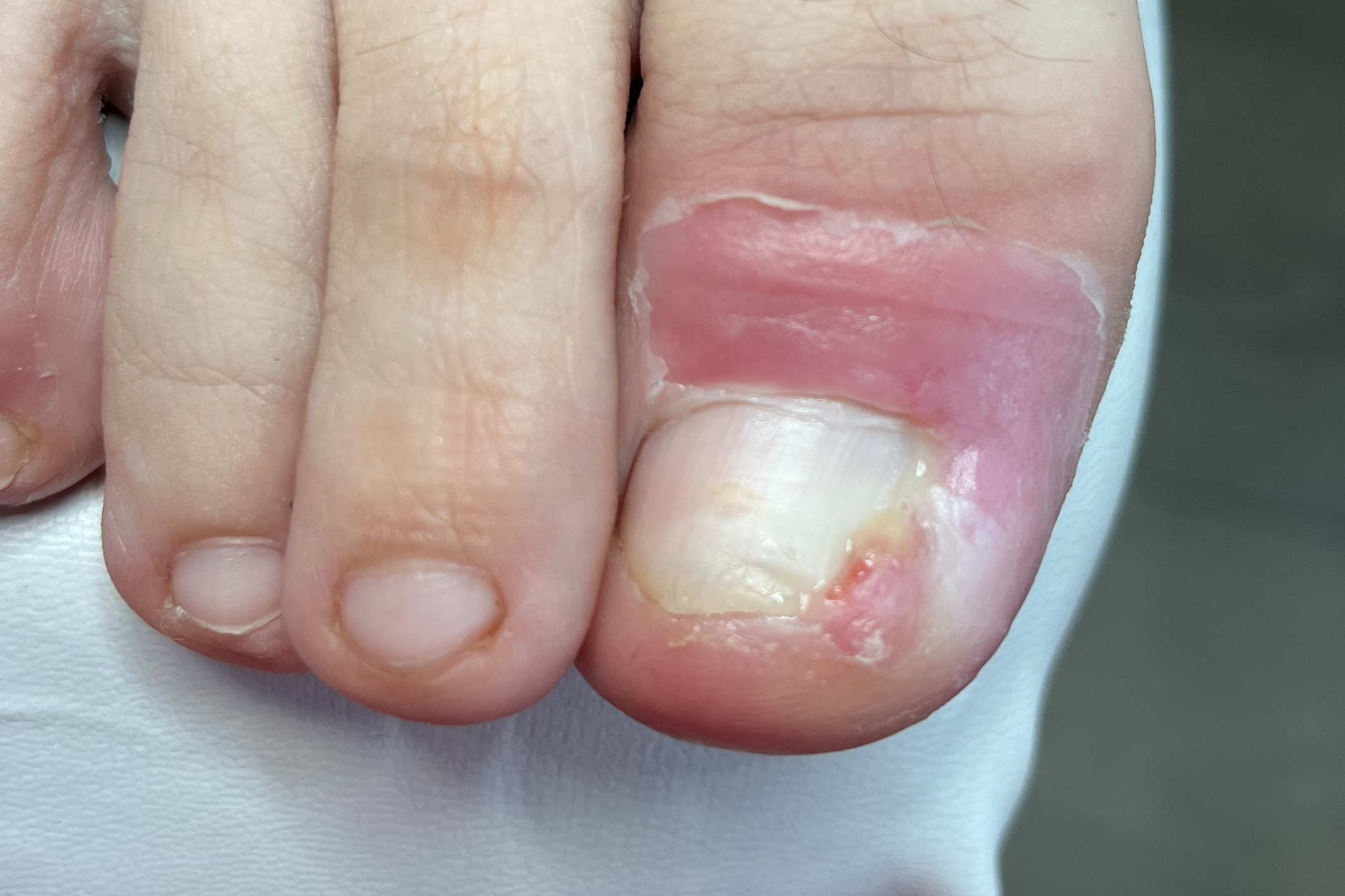 Ošetření zarostlého nehtu