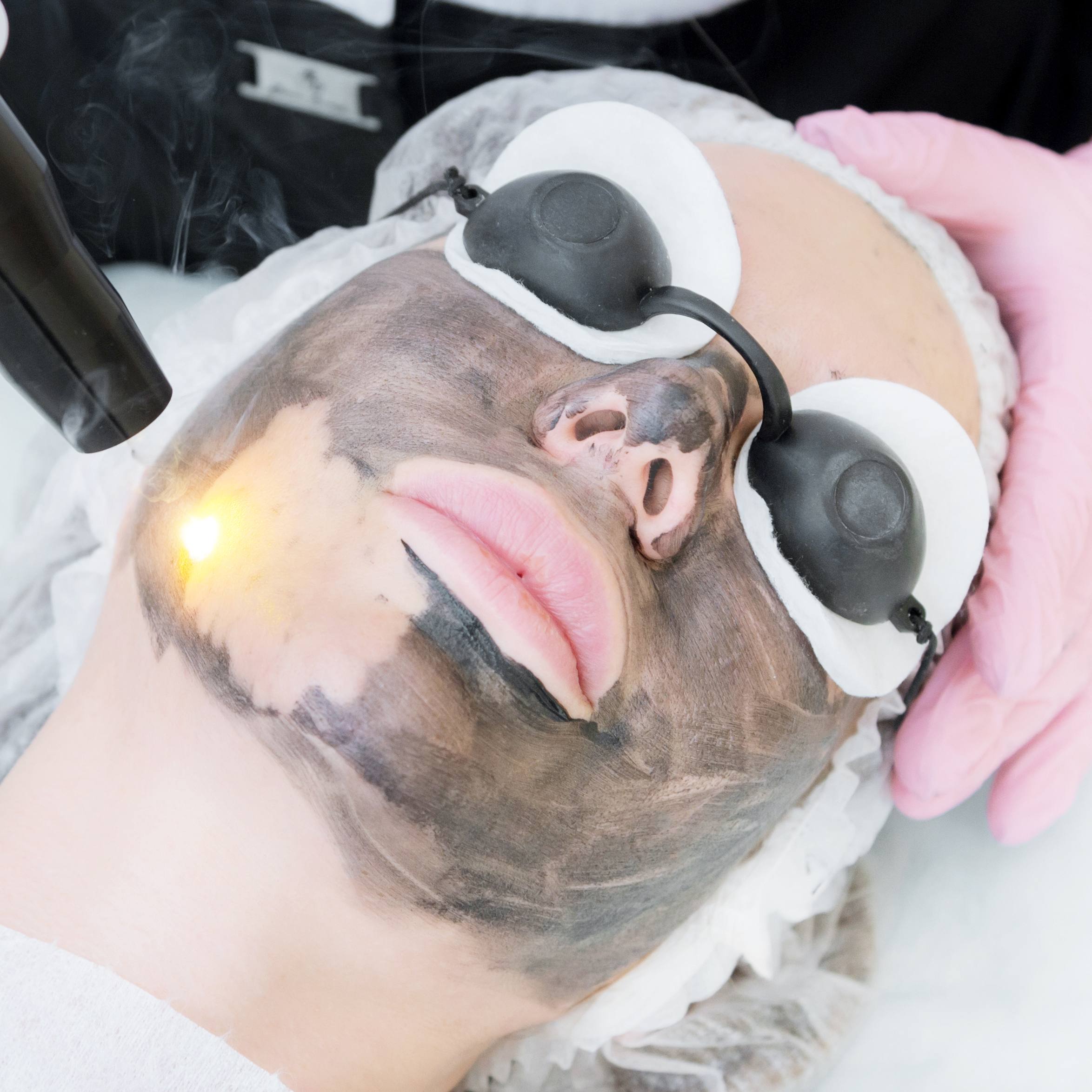 Carbon Peeling  Gesicht - Hals - Dekolleté ♀♂