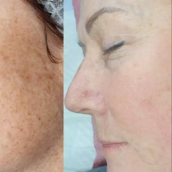 IPL odstranění pigmentace - obličej