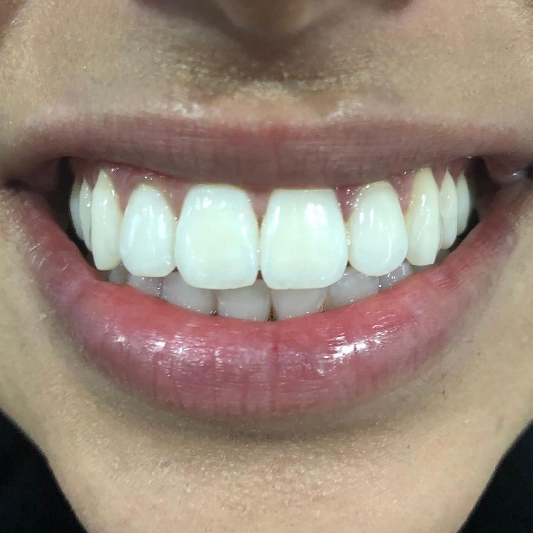 Intensive treatment (7 sessies)