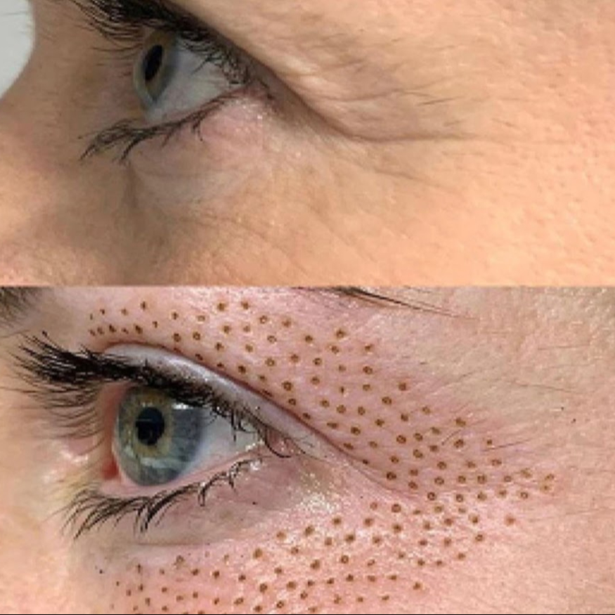 LIFTING PLAZMOU - horní víčka