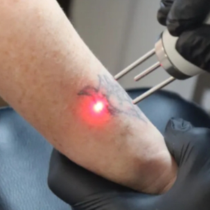 INTAKEGESPREK (+optionele behandeling)