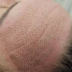 Plasma pen - vrásky na čele