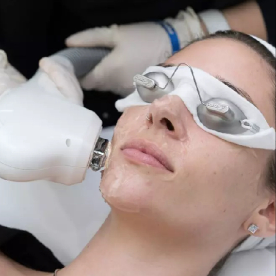 IPL epilace horní ret