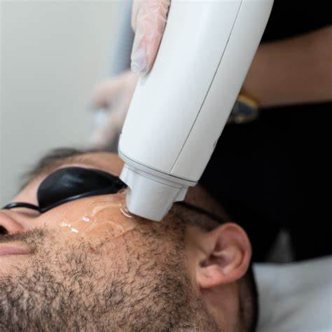 Depilação Laser SHR Patilhas ( Homem)