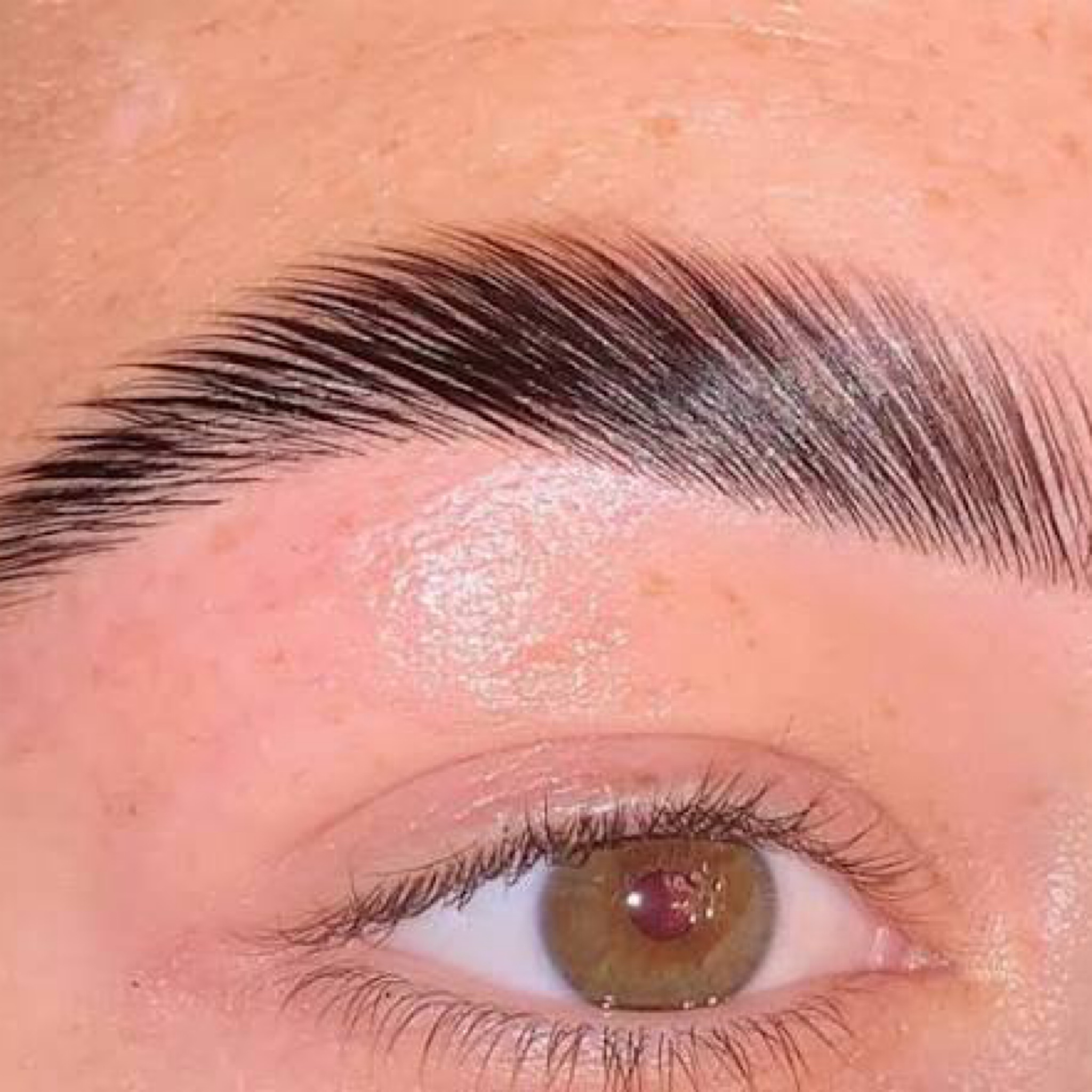 Brow lift
