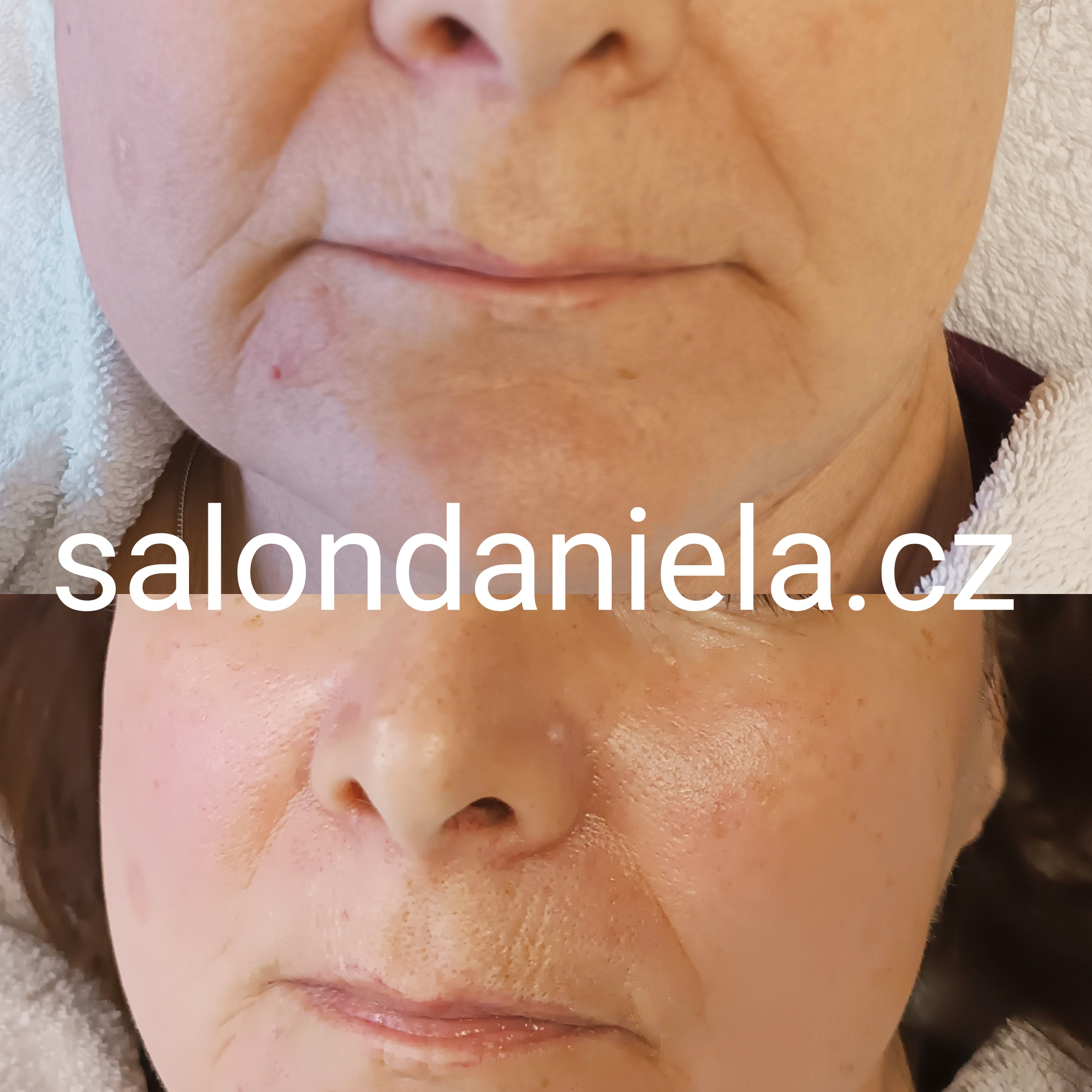 *NOVINKA*Lifting - kolagenové nitě , obličej: od 1300,-