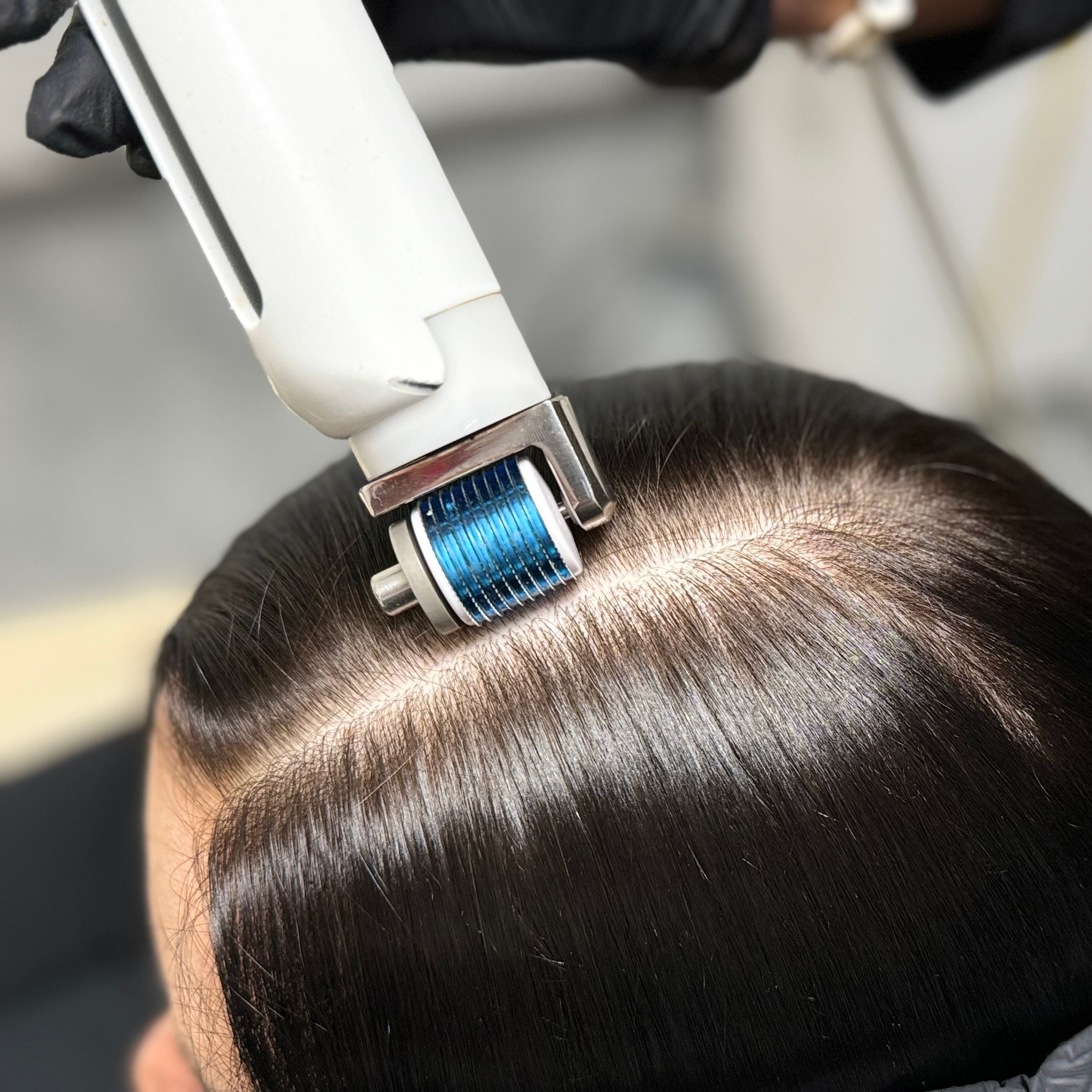 Čistenie pokožky hlavy a mikroihličkovanie - sérum NEOHAIR