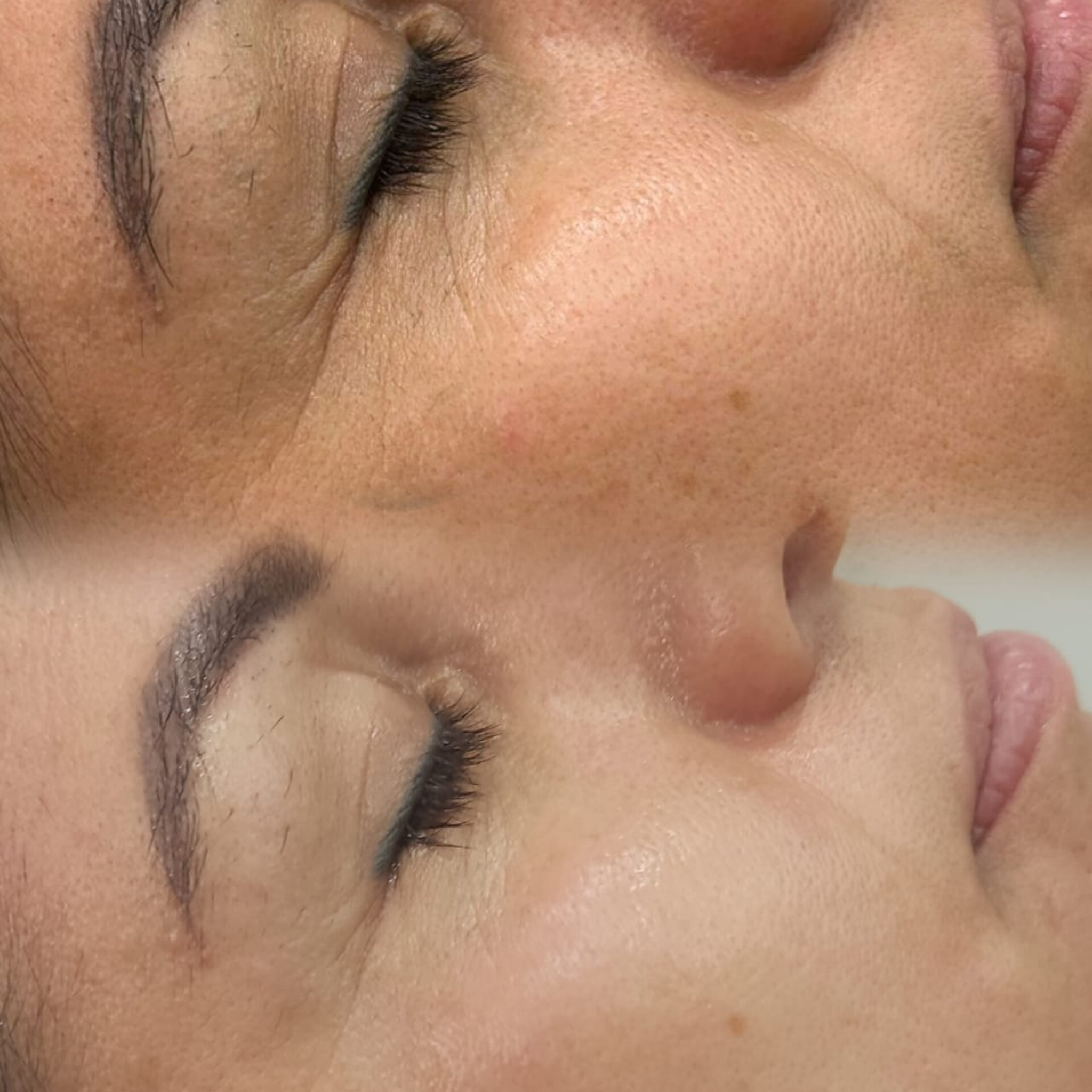 Nano Botox facial