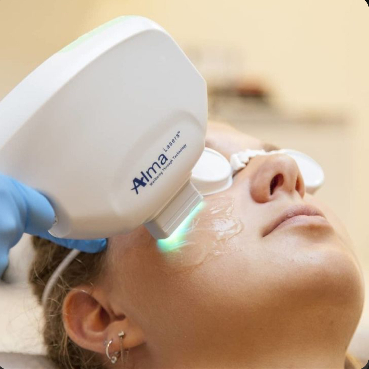 IPL Fotoomlazení / Fotorejuvenace - 60min