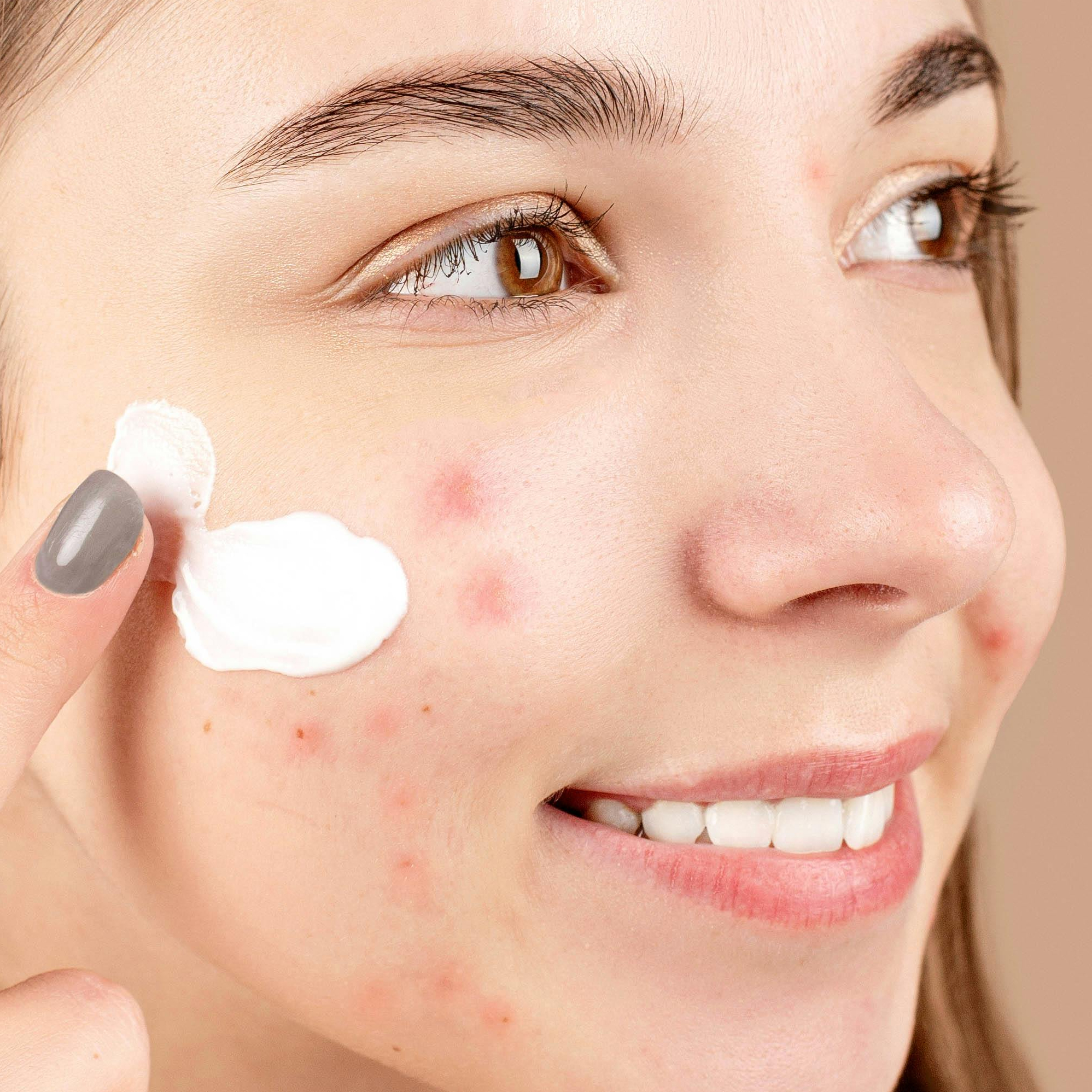 Ošetření proti akné - student (60 minut)