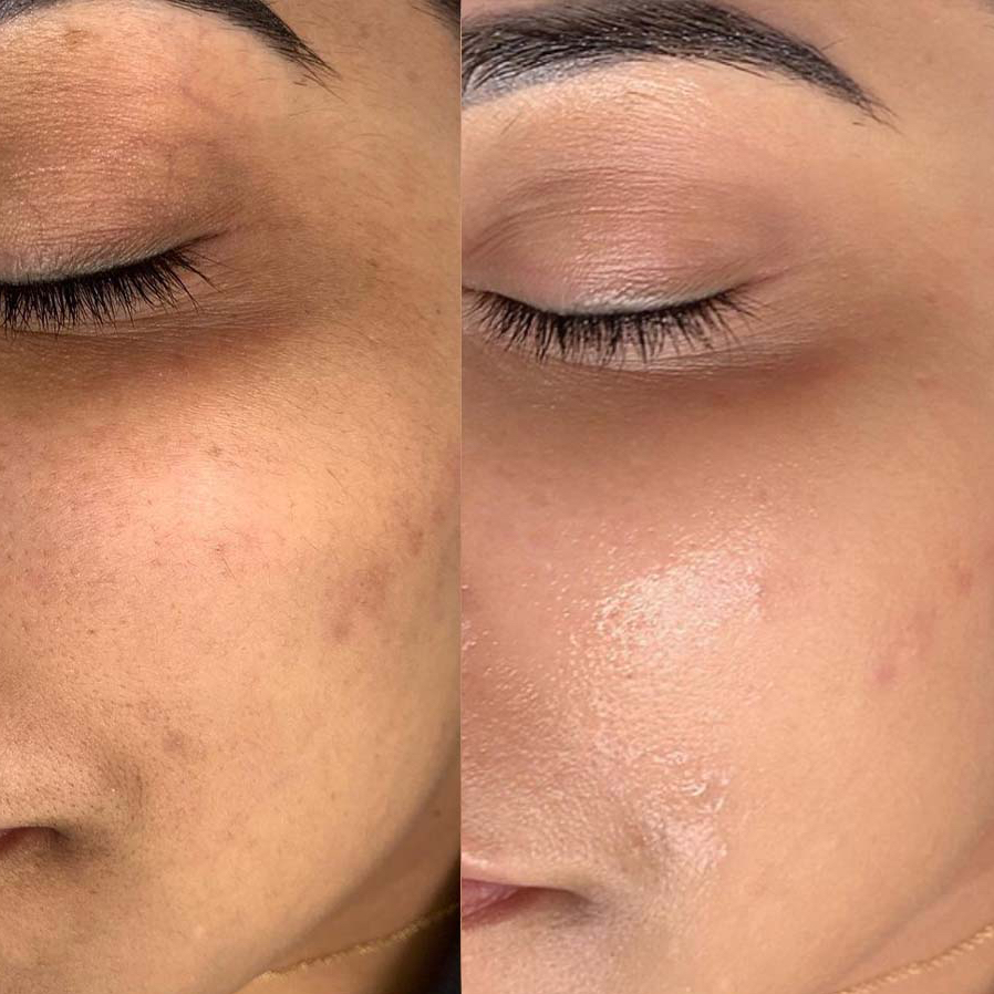 Mezoterapie s kyselinou hyaluronovou + peptidy - větší plocha