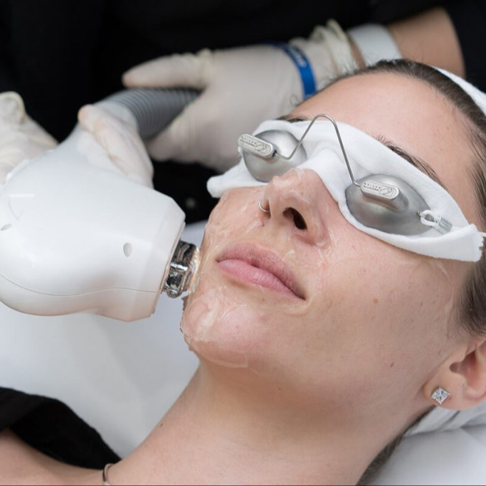 IPL epilace horní ret