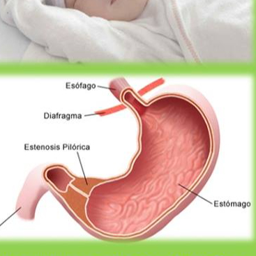 Stomaco (stenosi del Piloro)