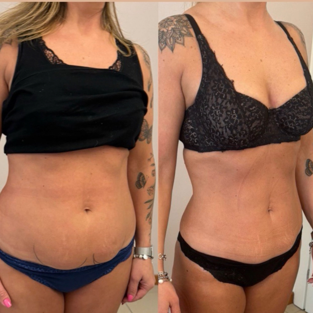 Kryolipolýza – AKCE listopad ! 4 hlavice