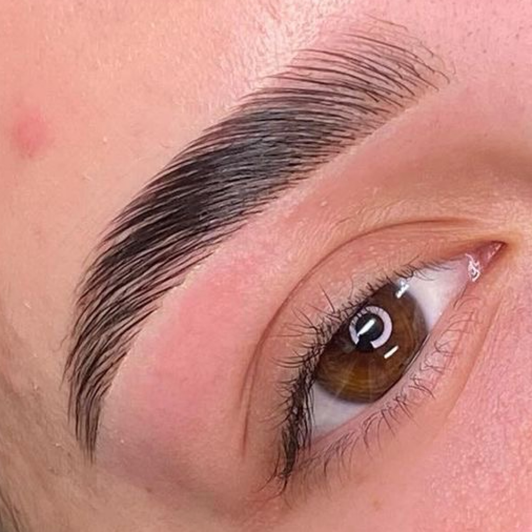 Brow lift