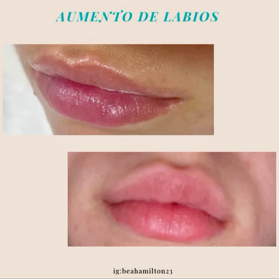 Acido hialuronico de 3,5 en dermapen o mas denso de armonia fac