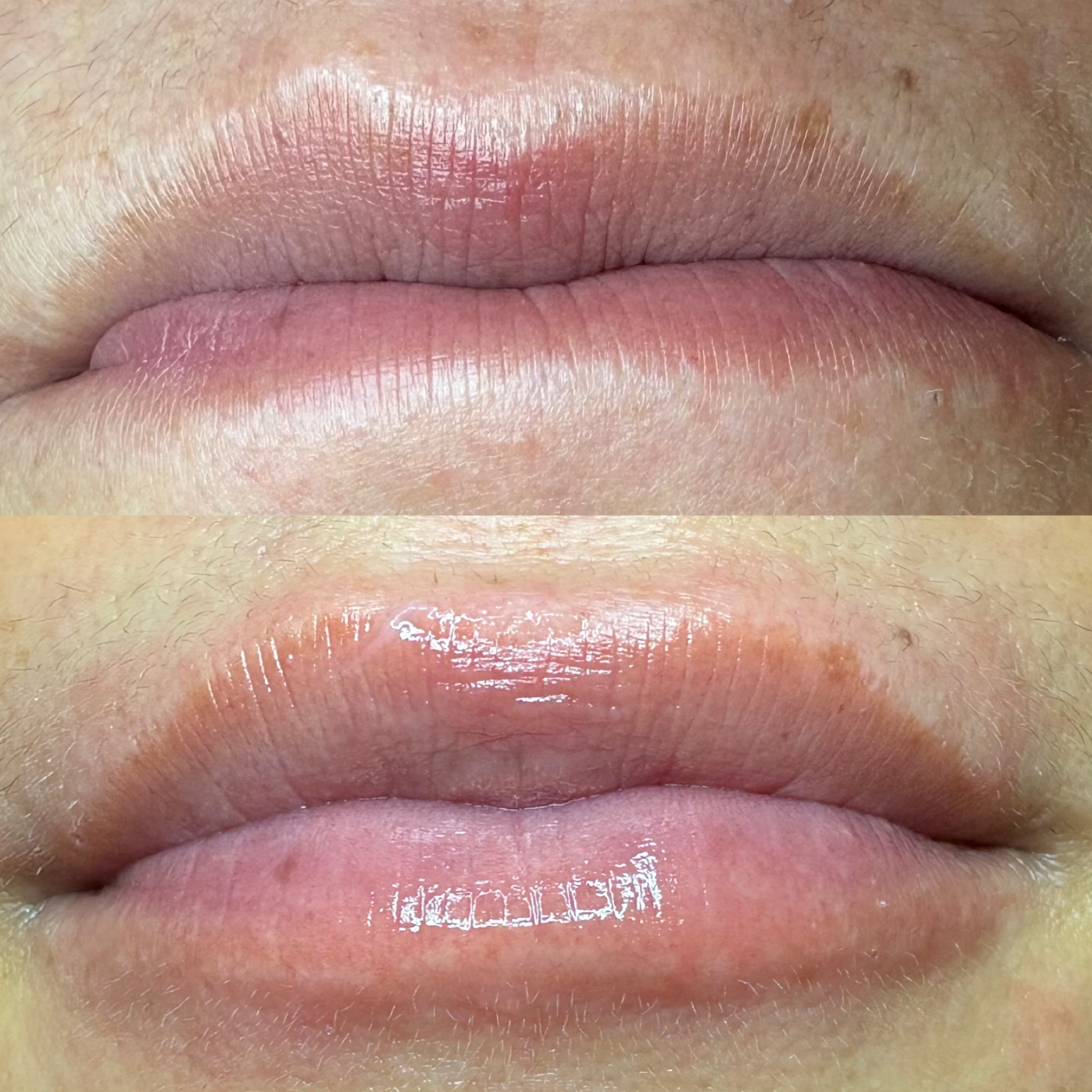 Hydra Lips avec ou sans Led Therapie
