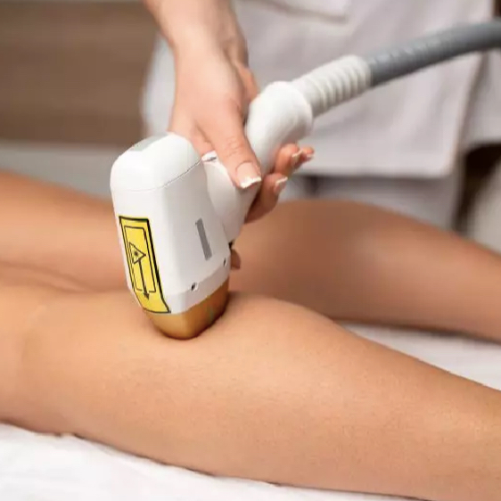 IPL epilace stehna nebo lýtka