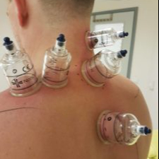 Shiatsu kiegészítő terápiákkal: köpöly, FDM, gyógymasszázs