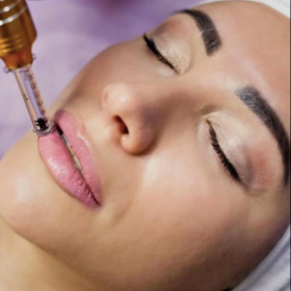 Zvětšení a vyživení rtů - hyaluron pen