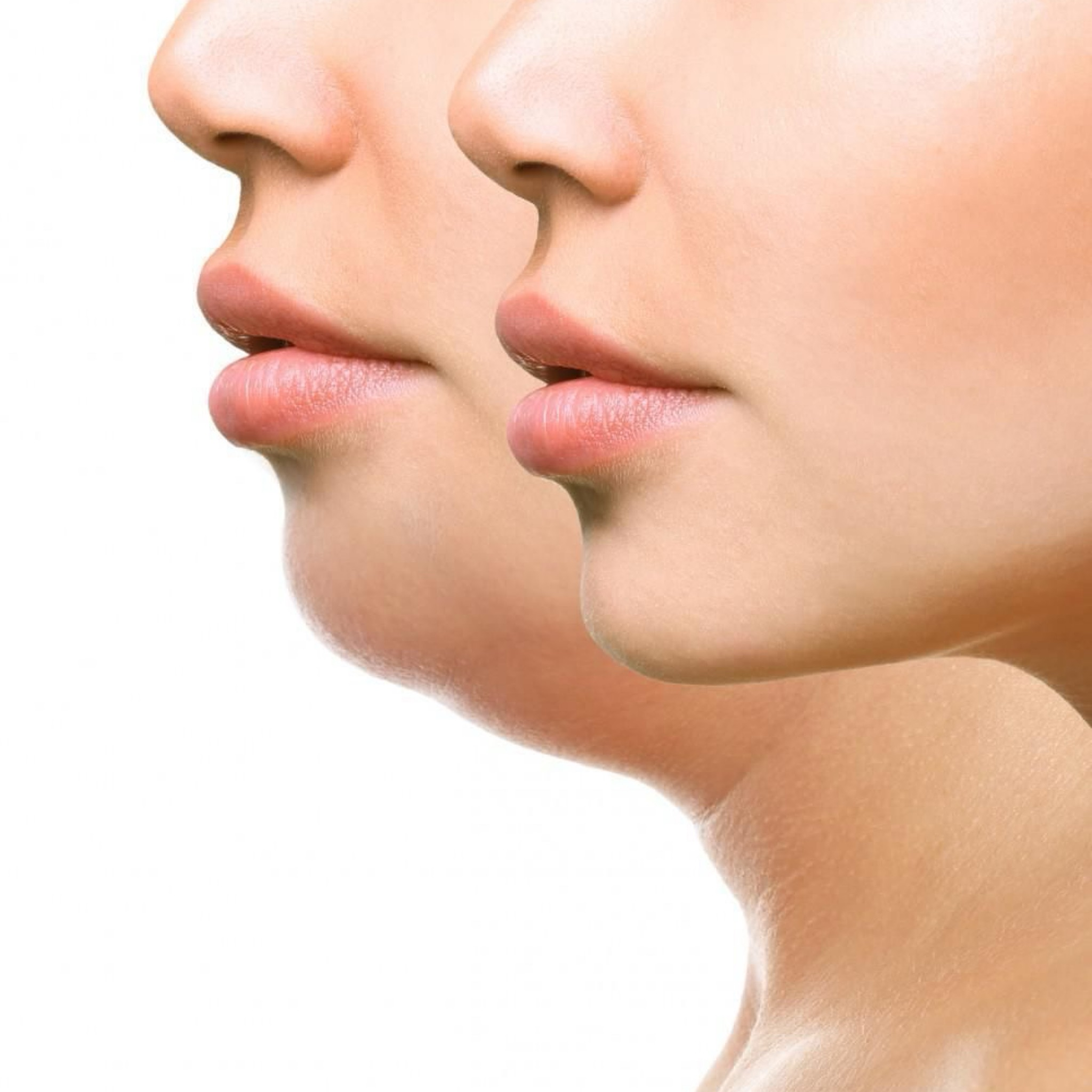 Mesolipo Terapie+VelaShape Liposukce - Podbradek