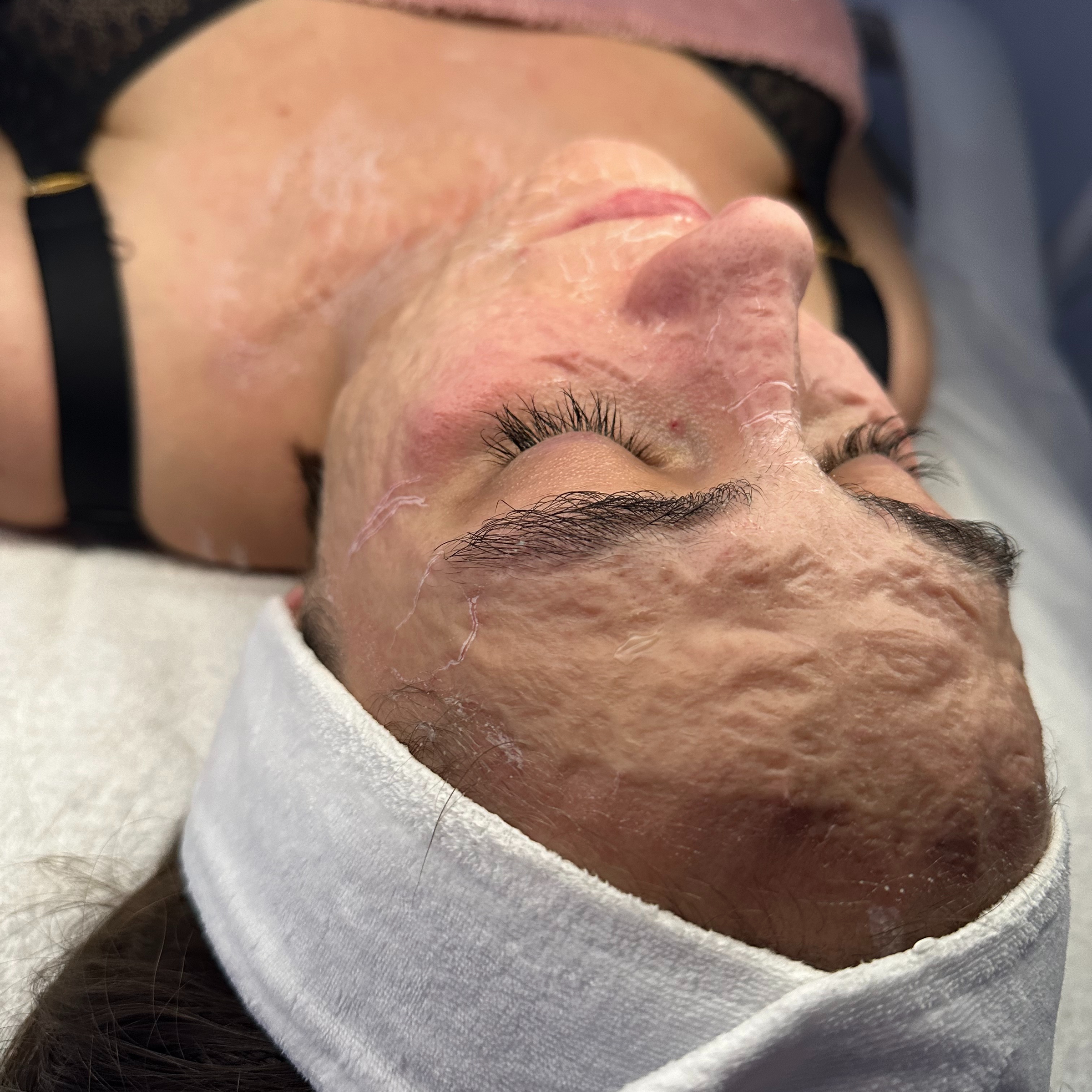 Ošetření BOTOXY ✤ konturovací botoxová maska